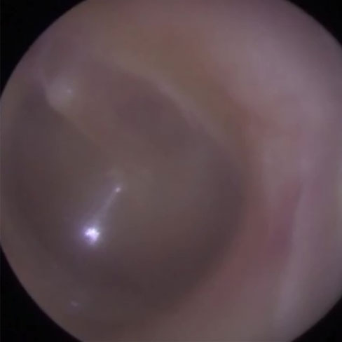 Ear canal after microsuction ear wax removal