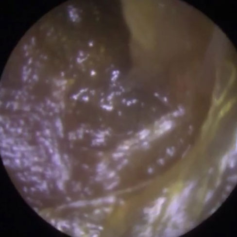 Ear canal before microsuction ear wax removal